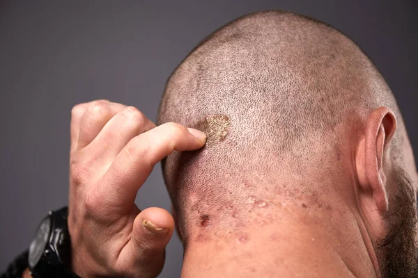 Homem Com Pele Seca Escamosa Cabeça Com Psoríase Fungos Nas — Fotografia de Stock