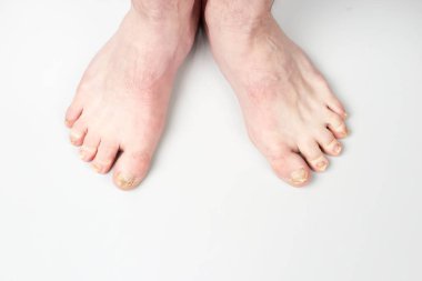 Ayak hastalığında mantar. Çivi bacaklarında mantar enfeksiyonu, onikomikozlu parmak, insan bacağında hasar..