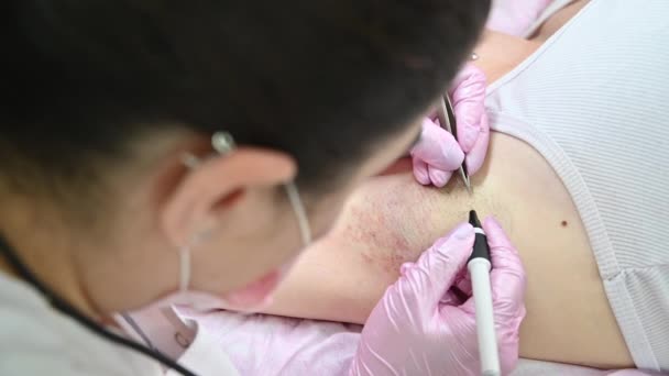 Procedimiento de eliminación del cabello de forma permanente en las axilas de las mujeres utilizando electro epiléptica — Vídeo de stock