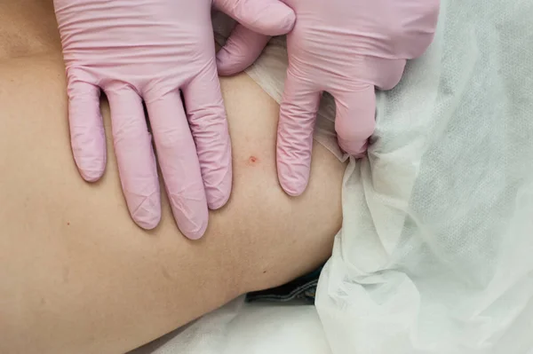 Medisch schoonheidsspecialist ziet ruimte op het menselijk lichaam na het operatief verwijderen van papillomavirus — Stockfoto