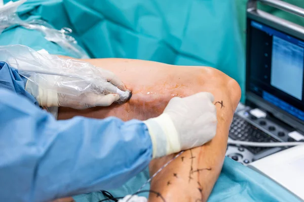 Varicose veins surgery act, a superficial veins problems, swollen skin