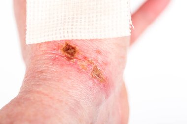 Bilek derisinde hidroksit sodyum asitle kimyasal yanıklar var. İltihaplı ve derin yara. Ev kazası, mavi eldivenlerin keskin olması yüzünden. Steril parafin gazlı bez. Seçici odak