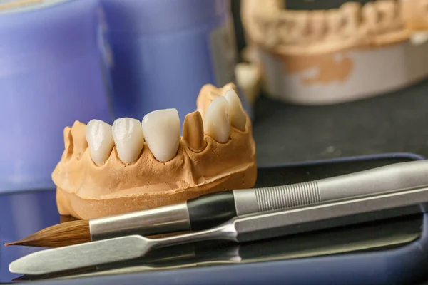 Zahnimplantat Wiederherstellung Der Zähne Zahnarzt Dentallabor Zahnklinik Implantate Für Den — Stockfoto