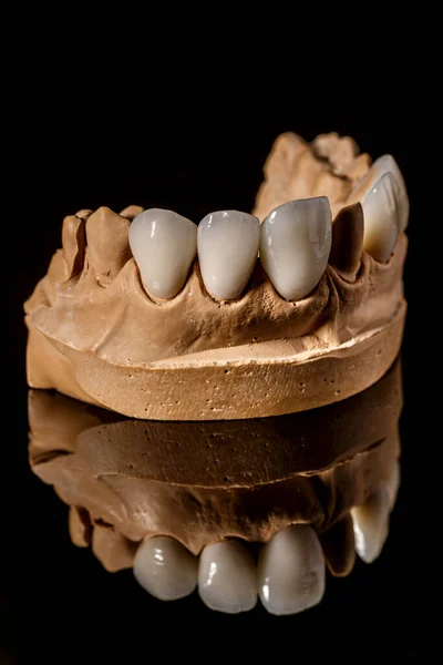 Zahnimplantat Wiederherstellung Der Zähne Zahnarzt Dentallabor Zahnklinik Implantate Für Den — Stockfoto