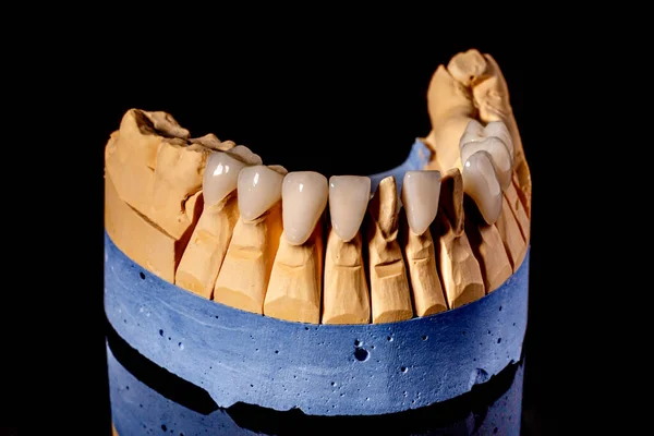 Zahnimplantat Wiederherstellung Der Zähne Zahnarzt Dentallabor Zahnklinik Implantate Für Den — Stockfoto