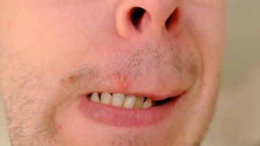 Açık gri arka planda dudağında uçuk olan bir adam. Erkek dudaklarında uçuk var. Ağrılı virüs konsepti. Adamın dişleri ağrıyor..