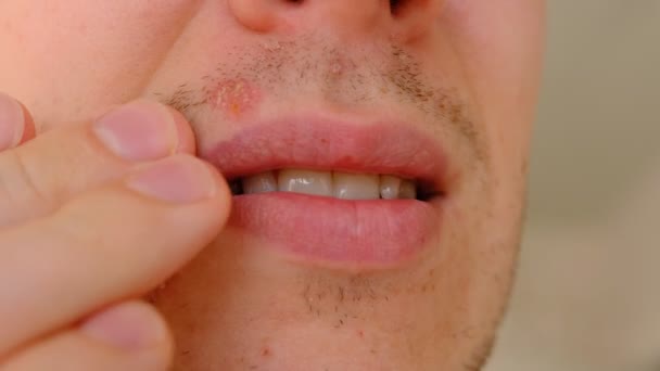 Mężczyzna Opryszczką Ustach Jasnoszarym Tle Zimny Ból Męskich Ustach Koncepcja — Wideo stockowe