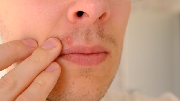 Man Met Herpes Lippen Tegen Lichtgrijze Achtergrond Koudpijn Lippen Van — Stockvideo