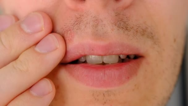 Man Met Herpes Lippen Tegen Lichtgrijze Achtergrond Koudpijn Lippen Van — Stockvideo