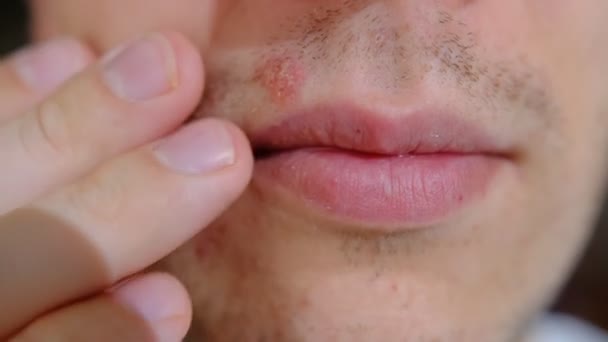 Mann Mit Herpes Auf Den Lippen Vor Hellgrauem Hintergrund Erkältungswund — Stockvideo