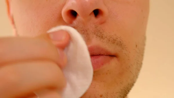 Man with herpes on lips against light grey background. Cold sore on a man lips. Sore virus concept. Man treat sore by cotton disk with antiseptic to remove old cream and prevent spreading of virus on the other parts of the skin.