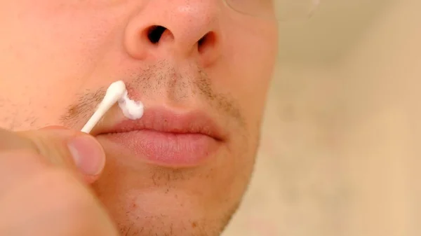 Man with herpes on lips against light grey background. Cold sore on a man lips. Sore virus concept. Man touch sore by cotton swab and use cream for treatment and therapy sore. Man spread white cream on a sore on his lip by cotton swab.