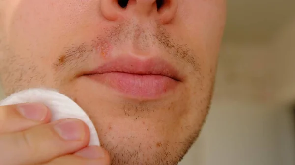 Man with herpes on lips against light grey background. Cold sore on a man lips. Sore virus concept. Man treat sore by cotton disk with antiseptic to prevent spreading of virus on the other parts of the skin.