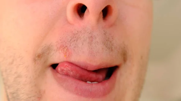 Man Met Herpes Lippen Tegen Lichtgrijze Achtergrond Koudpijn Lippen Van — Stockfoto