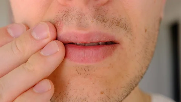 Man with herpes on lips against light grey background. Cold sore on a man lips. Sore virus concept. Man touch sore by fingers.