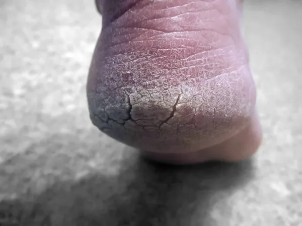 Derin çatlaklar, bir erkeğin topuğunda nasırlar.