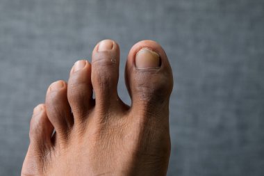 Toenail cuts and bruises. Concept illustration of the need for health care, pedology or dermatology