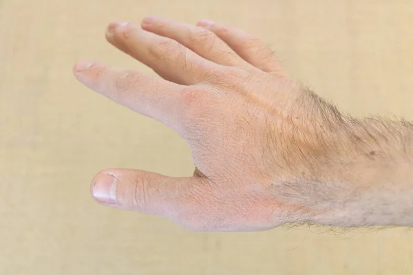 Крупный план сломанной руки человека — стоковое фото