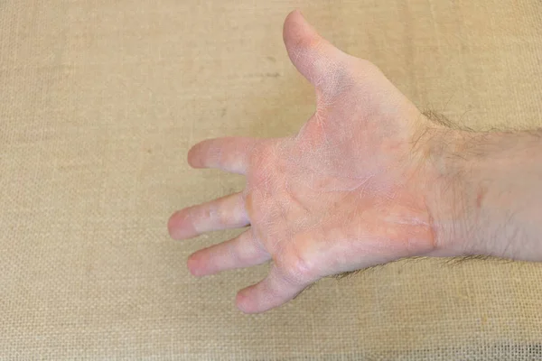 Una mano de hombre deshidratada con grietas debido al viento frío de principios de primavera concepto —  Fotos de Stock