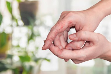 Bir kadının ellerindeki deri sedef hastalığı. Hastanın derisinde soyulma, kızarıklık ve çatlaklar var. Kronik dermatolojik hastalık. Çok fazla nemden dolayı el sorunu var..