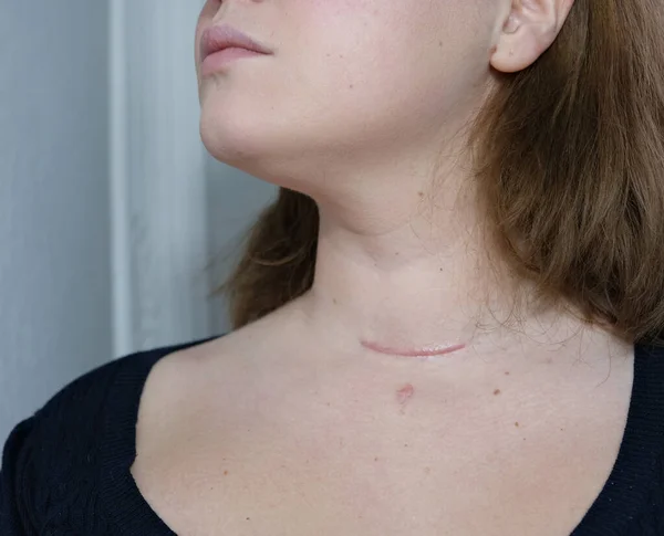 Scar Neck Surgical Wounds Removal Tumor Thyroid Cancer Red Scar — Stock Photo, Image