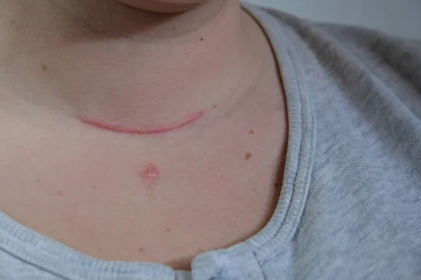 Scar on the neck. surgical wounds, removal of tumor and thyroid cancer. Red scar on the larynx, cut on the skin. Surgery and treatment Thyroidectomy, Hemithyroidectomy, Hashimoto\'s thyroiditis