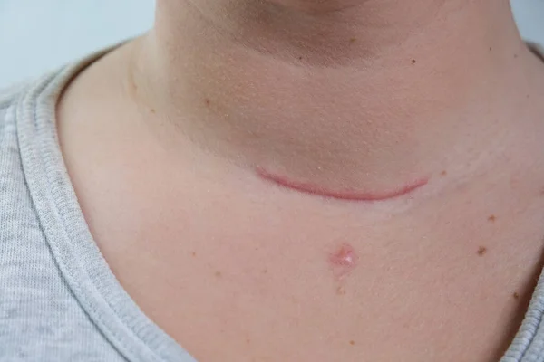 Cicatrice Sul Collo Ferite Chirurgiche Rimozione Del Tumore Del Cancro — Foto Stock