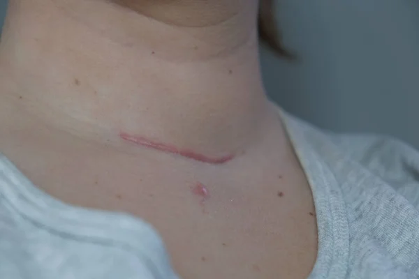 Scar on the neck. surgical wounds, removal of tumor and thyroid cancer. Red scar on the larynx, cut on the skin. Surgery and treatment Thyroidectomy, Hemithyroidectomy, Hashimoto\'s thyroiditis