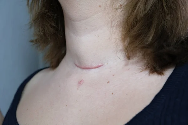 Cicatriz Cuello Heridas Quirúrgicas Extirpación Tumor Cáncer Tiroides Cicatriz Roja Imagen De Stock