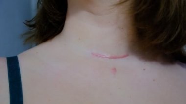 Boynunda yara var. Cerrahi yaralar, tümörün alınması ve tiroid kanseri. Gırtlakta kırmızı yara, deride kesik. Ameliyat ve tedavi tiroidektomi, hemiroidektomi, Hashimoto tiroidi.