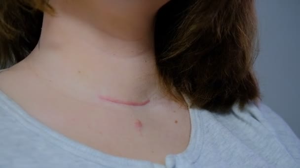 Cicatriz Cuello Heridas Quirúrgicas Extirpación Tumor Cáncer Tiroides Cicatriz Roja — Vídeos de Stock