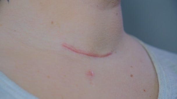 Cicatriz Pescoço Feridas Cirúrgicas Remoção Tumor Câncer Tireóide Cicatriz Vermelha — Vídeo de Stock