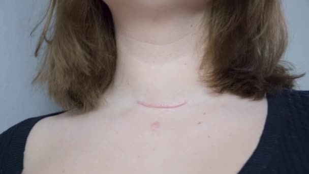 Gâtul Fetei Mişcare Marcați Gât După Operație Postoperator Nou Scar — Videoclip de stoc