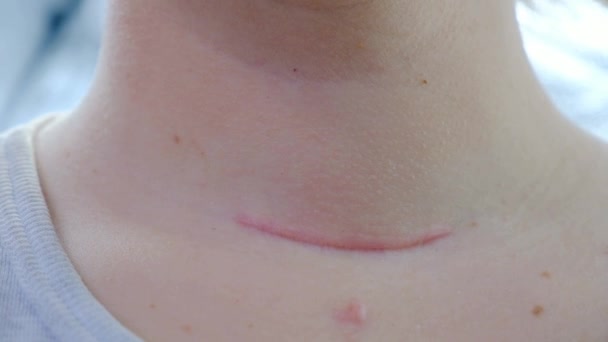 Cuello Chica Movimiento Cerca Marca Cuello Después Cirugía Nueva Cicatriz — Vídeos de Stock