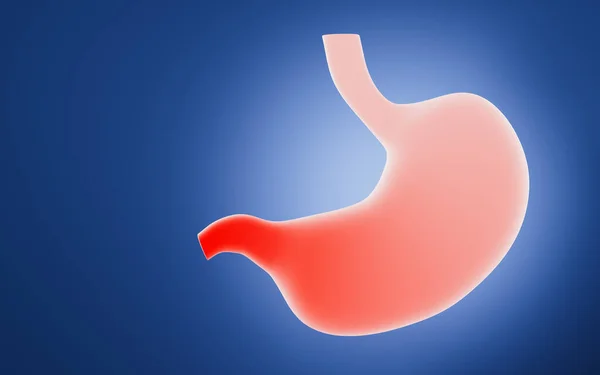 Inflammation of the stomach, gastric diseases, 3d rendering. Computer digital drawing.