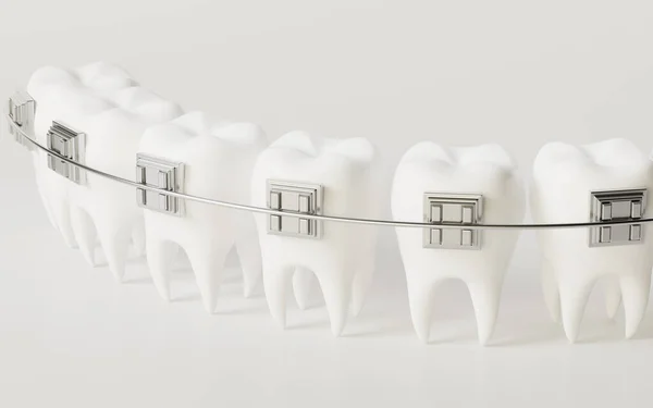 Teeth Brace White Background Rendering Computer Digital Drawing — 스톡 사진