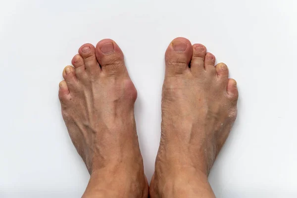 A foot with a gout bunion compared with a normal one not affected by the condition isolated in white background.