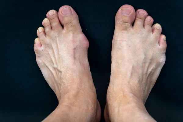 A foot with a gout bunion compared with a normal one isolated in black background.