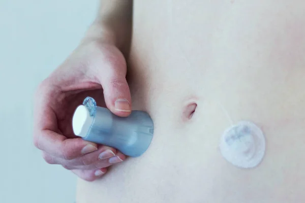 Woman placing an infusion set on her belly