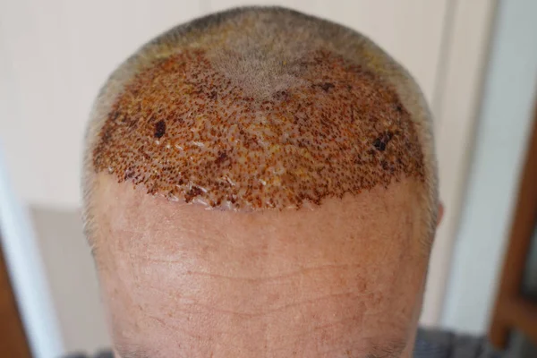 hair roots, hair transplant lotion, a newly transplanted head (5th day of hair transplant)
