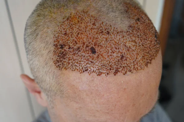 hair roots, hair transplant lotion, a newly transplanted head (5th day of hair transplant)