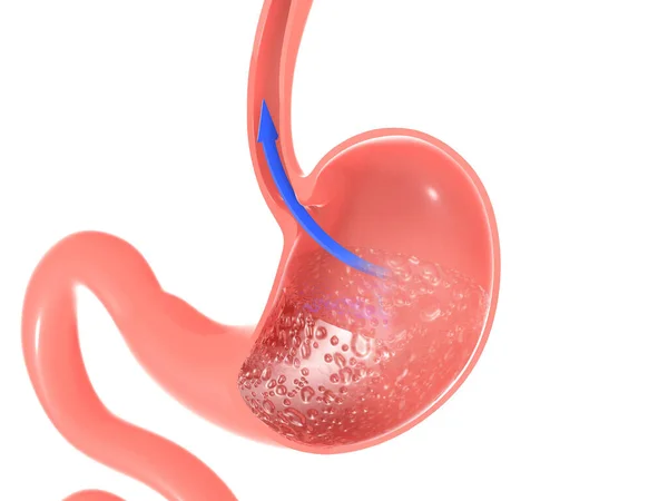 Illustration Stomach Showing Reflux Food Esophagus Arrow Pointing Movement Cropped — Stockfoto