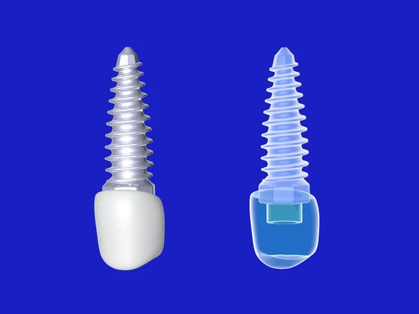 2つの異なるグラフィックスタイルで歯科インプラントの3Dイラスト 青の背景にしっかりと透明感のある技術イメージ ガラス — ストック写真