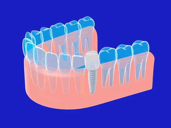 Illustration Eines Grafischen Isometrischen Zahnimplantats Anatomisches Bild Der Transparenten Prothese — Stockfoto