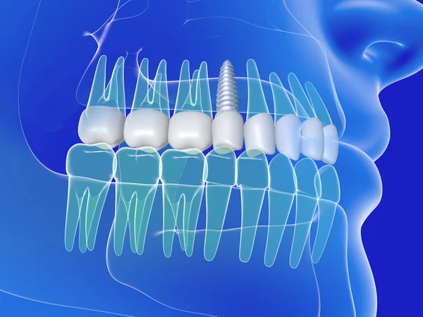Απεικόνιση Ενός Οδοντικού Εμφυτεύματος Ανατομική Εικόνα Των Δοντιών Και Του — Φωτογραφία Αρχείου