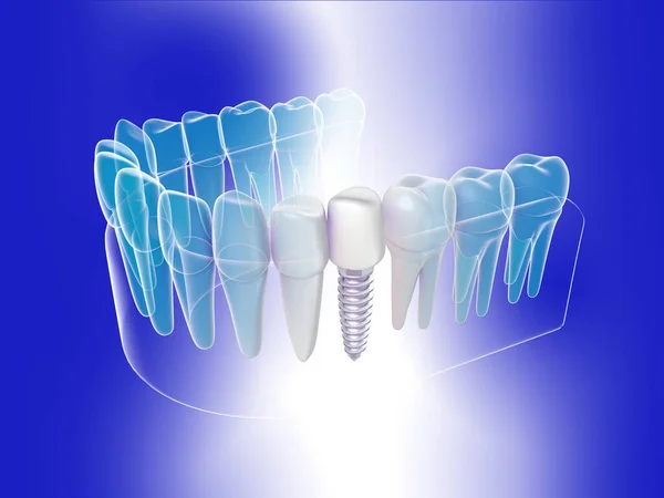 Grafik üç boyutlu, izometrik stil diş implantı. Mavi arkaplandaki şeffaf takma dişin anatomik görüntüsü.