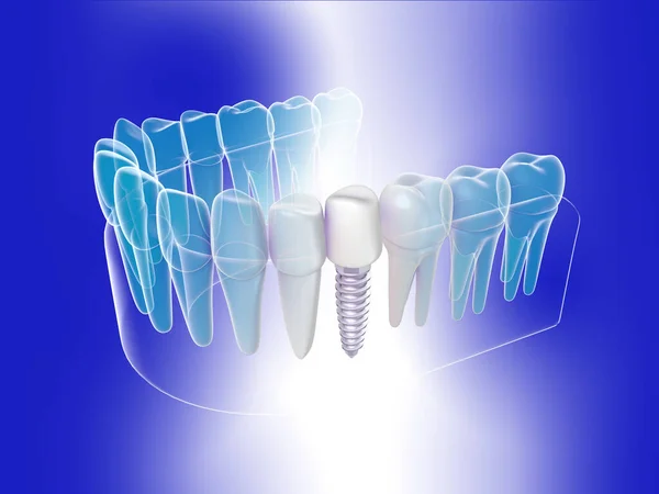Απεικόνιση Ενός Γραφικού Ισομετρικού Τύπου Οδοντικού Εμφυτεύματος Ανατομική Εικόνα Της — Φωτογραφία Αρχείου