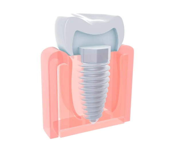 Bir diş ya da diş implantının anatomik görüntüsünün 3 boyutlu çizimi. Kemiğe çivilenmiş. Beyaz arkaplanda şeffaf biçim.