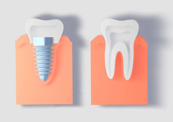Normal bir dişin yanındaki sakızda üç boyutlu diş implantı. Kesik kağıt simülasyonu. Beyaz arkaplanda ön görünüm.