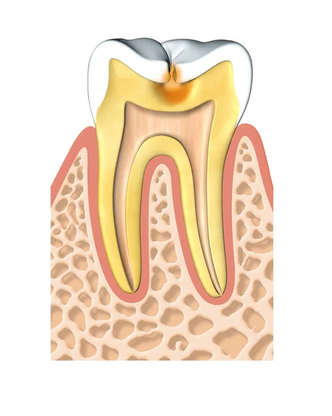 Hasarlı bir dişin anatomik görüntüsünün 3 boyutlu çizimi. Beyaz arkaplanda gerçekçi bir görünüm, sakız ve kemiğin ön görünümü.